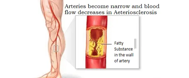 Nano Robots in Treatment of Arteriosclerosis