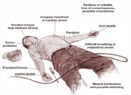 Severity of Injury in Electrical Shock